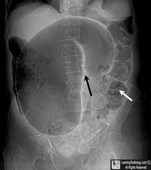 <p>Presentation: sudden onset bilious vomiting, abdominal distension, pain, rapid progression to shock</p><p>Evaluation:</p><p>Upper GI series → corkscrew appearance</p><p>u/s:  whorlpool </p>