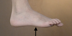 <p>The sole or posterior surface of the foot.</p>