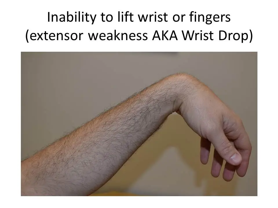 <p>AKA: Wrist Drop/Radial Nerve Palsy</p><ul><li><p><span style="background-color: transparent;"><mark data-color="yellow" style="background-color: yellow; color: inherit;">Presents two ways:</mark></span></p><ul><li><p><span style="background-color: transparent;">Paralysis affects all muscles innervated by posterior interosseous nerve, with inability to extend MP joints of thumb, index, long, ring, or small fingers.&nbsp;</span></p></li><li><p><span style="background-color: transparent;">Person cannot extend MP joint of one or more digits.&nbsp;</span></p></li></ul></li></ul><p></p>