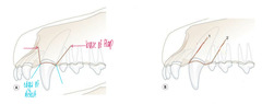 <p>Which flap design is preferred and why?</p>
