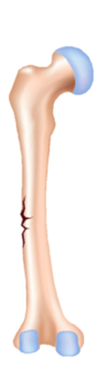 <p>incomplete fracture where one side of the bone breaks and the other side bends</p><p>common in children because their bones are more flexible than adults</p>