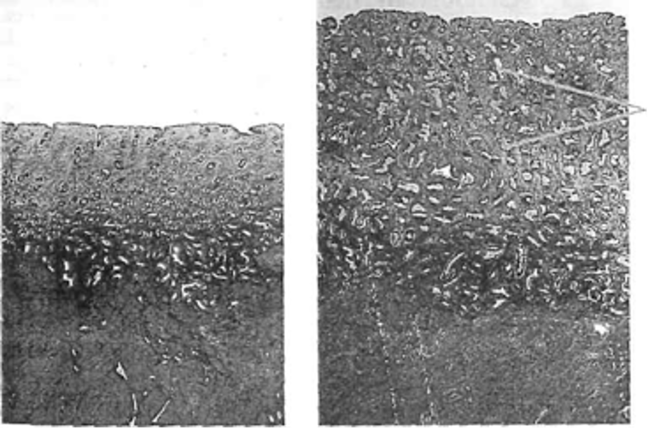 <ul><li><p>Image: Follicular → Luteal phase</p></li><li><p>Endometrial shedding during menstruation involves thickened endometrium, spiral arteries, and many active cells, causing tissue breakdown.</p></li><li><p>Can lead to pain and cramping due to muscle contractions.</p></li><li><p>Despite significant discomfort, society often under-recognizes menstrual pain compared to other ailments like headaches or colds.</p></li><li><p>Menstrual symptoms can impact daily activities, but awareness and accommodation are often limited.</p></li></ul><p></p>