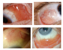 <p>What is the most likely diagnosis ?</p>
