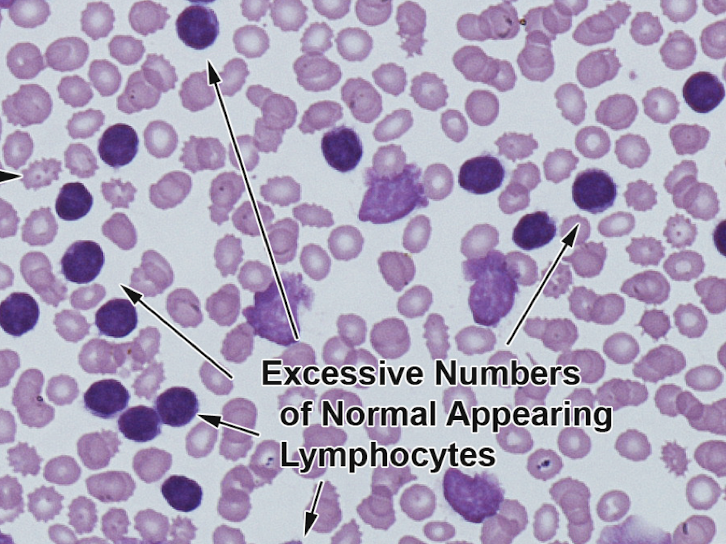 <p>Disorder with <span style="line-height: 19.55px;">increased lymphocyte count </span></p>