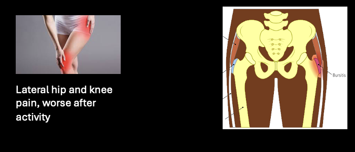 <p>-tenses IT band, so pain if engage TFL (no motor really impacted)</p><ul><li><p>pain during knee and/or hip flexion</p></li></ul><p>-TFL</p><p>-sup glutal n</p><p>-L5-S1</p><p>-No (glut n no sensory)</p>