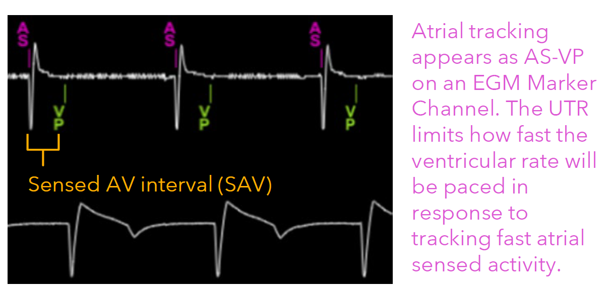 <p>This safeguards against excessively fast ventricular pacing during fast atrial arrhythmias.</p><p>Tracking modes help ensure atrioventricular (AV) synchrony</p>