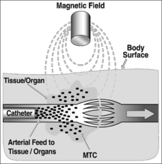 <p>method of drug targeting in which the drug is entrapped on paramagnetic materials and applied with the help of external magnetic field</p><p>Ex: removal of cancer from peritoneum in ovarian cancer</p>