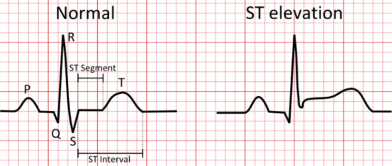 <p>elevated S-T segment represents:</p>