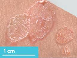 <p><span>Flakes or dry patches of skin made up of excess dead epidermal cells. These are associated with psoriasis.</span><br></p>
