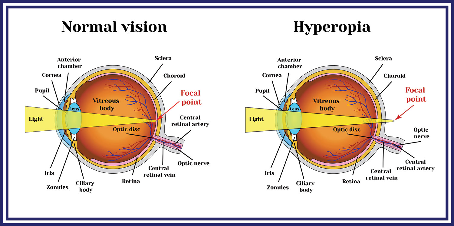 <p>PP: eye is too short→light passes past/through eye</p><p>RF: narrow angle glaucoma</p><p>CM: near→blurry vision<br>far→clear vision</p><p>TX: glasses+lenses<br>contact lenses</p>