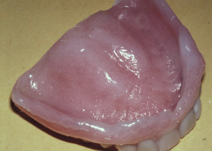 <p>What do you do during the relining appointment?</p>