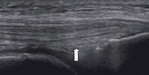 <ul><li><p><span style="background-color: transparent;">Location: articular surfaces where bone contacts adjacent bone surface</span></p><ul><li><p>Ex: Hoffa fat pad at knee, Kager’s fat pad at heel</p></li></ul></li><li><p><span style="background-color: transparent;">US appearance: hyperechoic and homogeneous</span></p></li></ul><p></p>