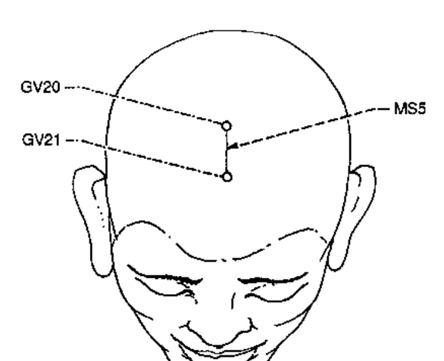 <p>From DU 20 to DU 21 along the midline of head</p><p><strong>-diseases in regions lower than the waist</strong></p><p><strong>-mental &amp; emotional diseases</strong></p><p><strong>-prolapsed rectum or uterus</strong></p><p><strong>-local vertex pain</strong></p>