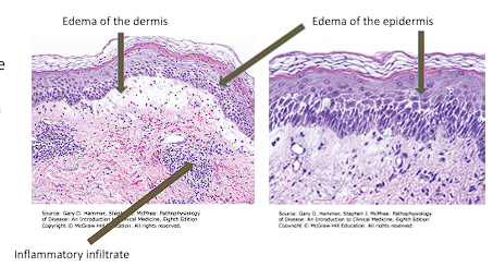 <ul><li><p><strong>Spongiosis </strong>(intracellular edema of epidermis)</p></li><li><p><strong>Separation</strong> of Keratinocytes</p></li><li><p>minimal perceptible microscopic changes→ severe blisters w/ fluid filled spaces</p></li><li><p><strong>Perivascular inflammation</strong> of superficial dermis</p></li><li><p>Infiltrate of <strong>lymphocytes and eosinophils</strong></p></li></ul><p></p>