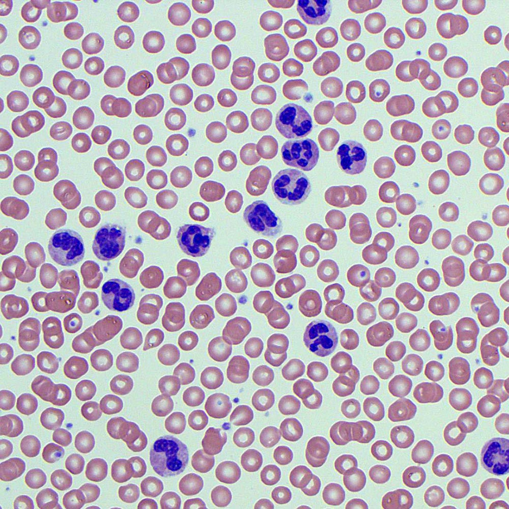 <p>NEUTROPHILIA</p>