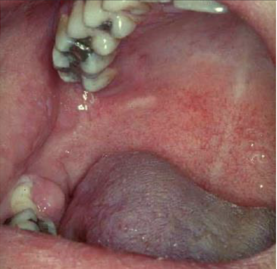 <p>what are these lesions associated with</p>