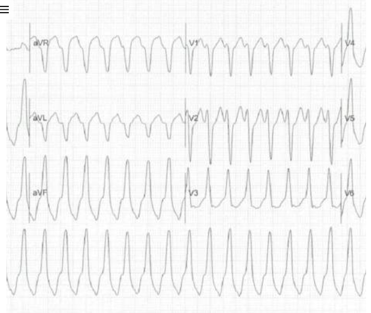 <p>where fast electrical signals begin in the RVOT near the pulmonary valve.</p>