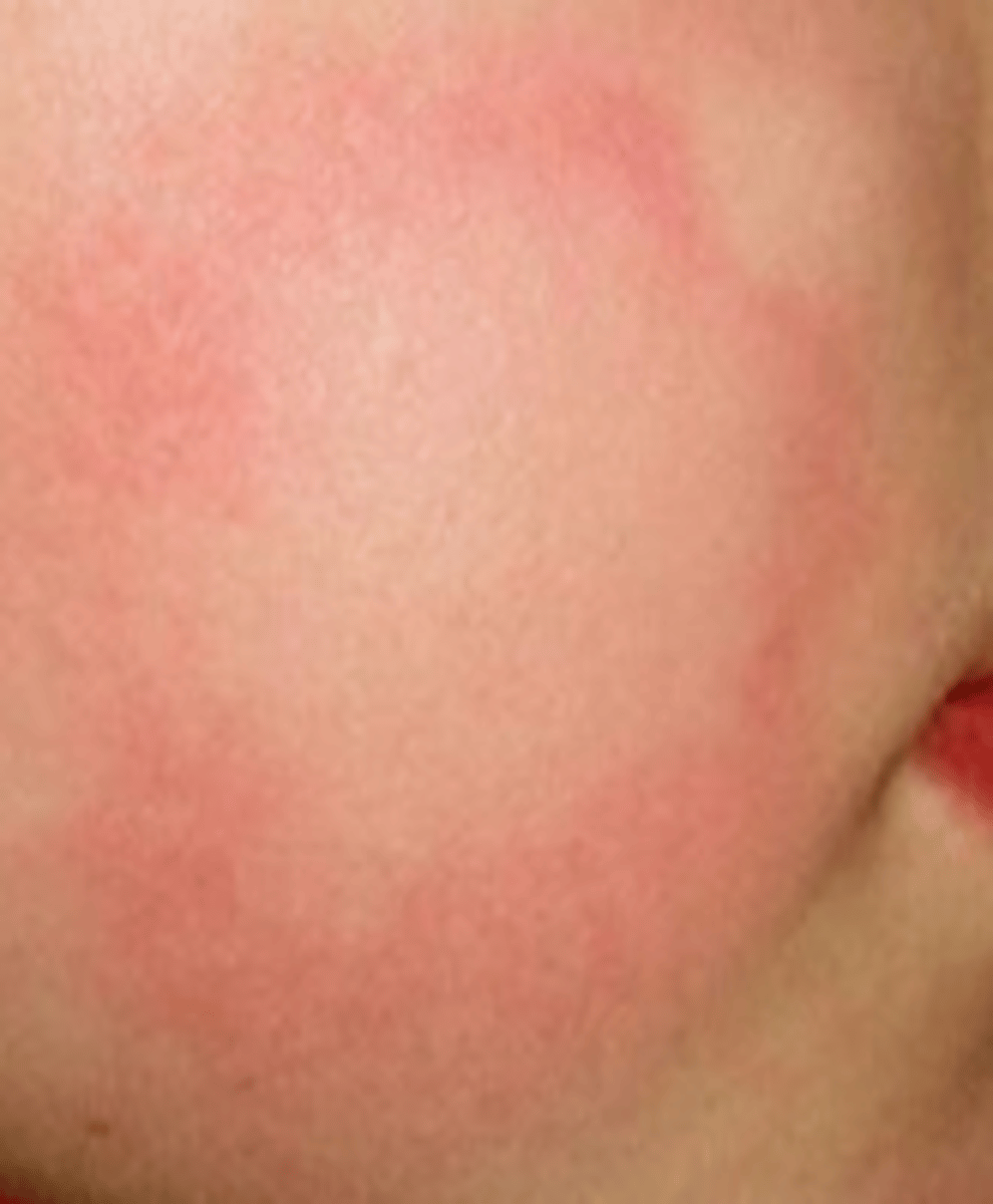 <p>vascular skin reactions and wheals with erythematous, raised borders, and blanch centers</p>