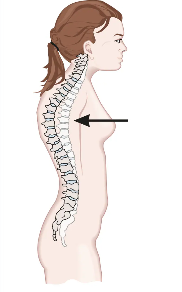 <p>Shoulders are rolled forward, which results in fatigue of the lower back and increases pressure on every region of the spine</p><ul><li><p>slouch</p></li></ul><p></p>