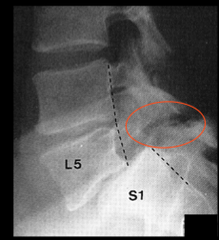 <p>forward slipping of one vertebra over another</p>