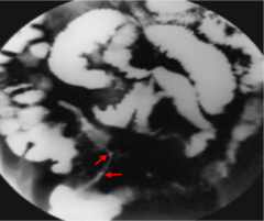 <p>DIAGNOSTIC TEST</p><p>-Ileocolonoscopy to distinguish between UC and colonic CD</p><p>--> Allows for biopsy</p><p>--> Ability to visualize "cobblestoning", strictures, or ulcers</p><p>-Capsule endoscopy is useful for staging or identifying small-bowel CD.</p><p>barium swallow (small bowel)</p><p>-may show ulcerations in between normal and abnormal mucosa, including fistulas, cobblestoning, strictures, or ulcers.</p><p>--> "string sign" on barium swallow, which signifies passage of contrast through a narrowed lumen.</p><p>Magnetic resonance imaging (MRI) with enterography is also with evaluating the small intestine.</p><p>--> Helpful with evaluating rectal or perirectal disease and fistulas.</p><p>CT scan of abdomen and pelvis or CT enterography can also be useful in some cases.</p>