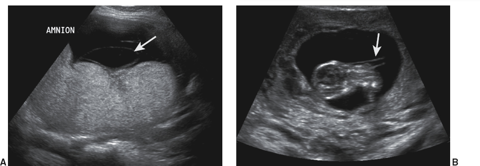 <p>Amputation of fetal parts or severe edema in the affected area</p><p>Thin, linear bands may be seen</p><p>Facial clefting</p>