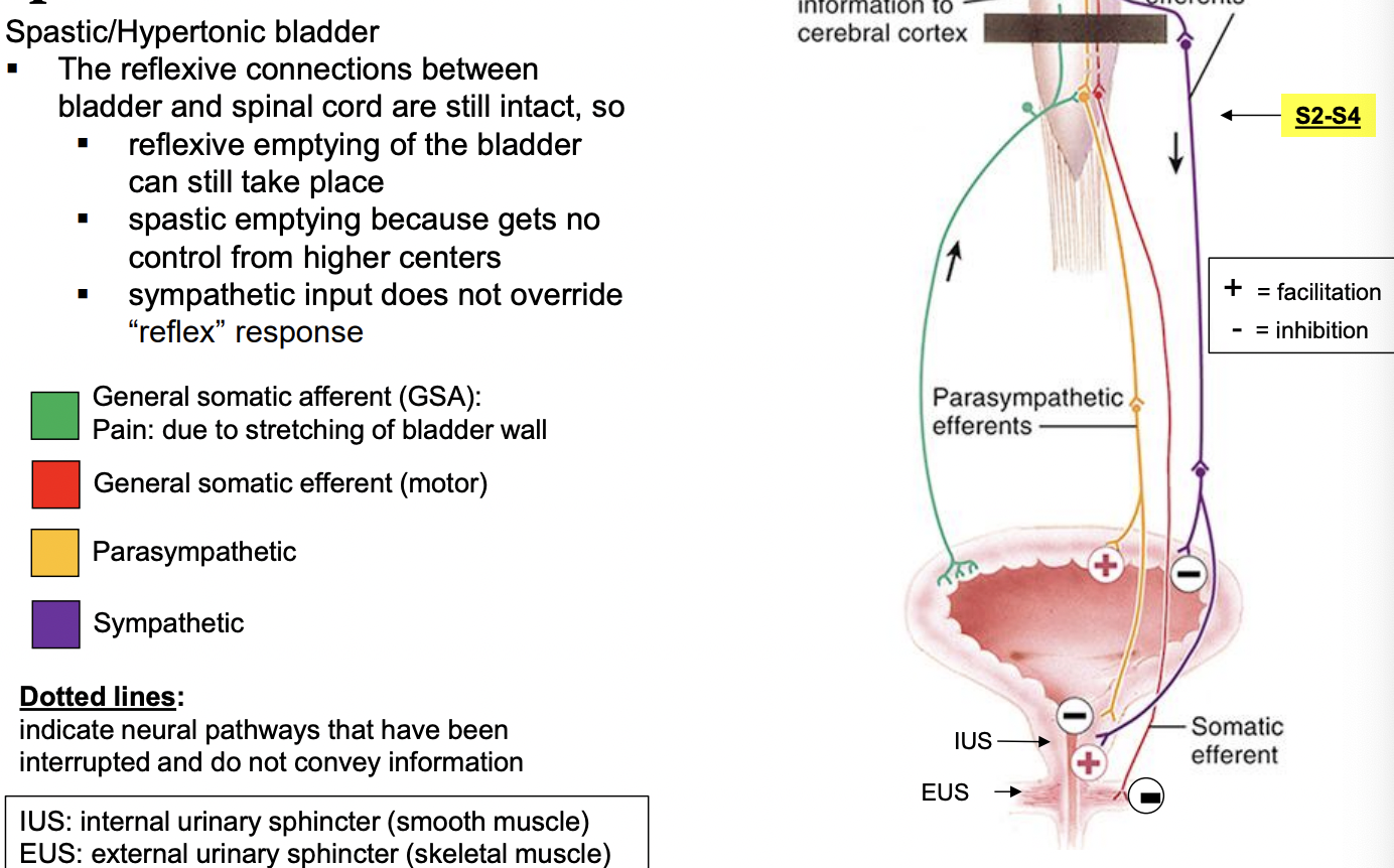 <p>Spastic/Hypertonic bladder </p><ul><li><p>the reflexive connective between bladder and spinal cord are sill intact, so</p><ul><li><p>reflexive emptying of the bladder can still take place</p></li><li><p>spastic emptying because gets no control from higher centers </p></li><li><p>sympathetic input does not override “reflex” response </p></li></ul></li></ul><p></p>