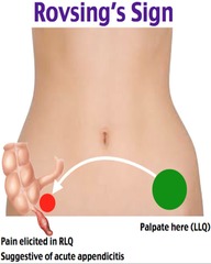 <p>Pain migration indicating appendicitis.</p>