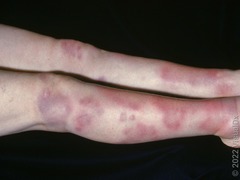 <p>+ URI sx 1-3 wks before rash</p>