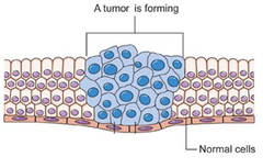 <p>cancer</p>