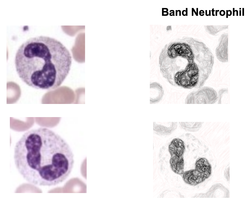 <ul><li><p><span style="background-color: transparent;">the primary first responders of the innate immune system. Produced daily in the bone marrow, they circulate in the blood and quickly migrate to sites of infection or injury to destroy invading pathogens and clear cellular debris</span></p></li><li><p><span style="background-color: transparent;">Circulation is less than 24 hours, but lifespan can be 3-5 days in tissues.</span></p></li><li><p><span style="background-color: transparent;">Differential percentage range: 45-75%</span></p></li></ul><p></p>