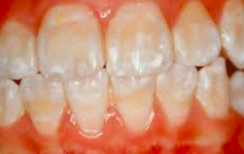 <p>quality defect</p><p>also produces hypomineralized enamel</p><p>caused by <span style="color: red;">abnormal initiation of enamel crystallites</span> followed by defective mineralization</p><p><strong>clinical appearance:</strong></p><ul><li><p><span style="color: red;">chalky yellow-brown</span> enamel that wears rapidly</p></li><li><p>very soft</p></li></ul><p></p>