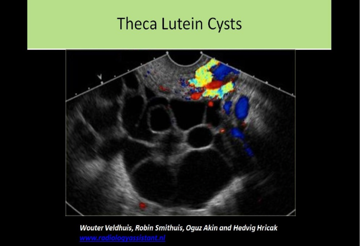 <p>C. theca lutein cyst</p><p>Theca lutein cysts are associated with increased levels of hCG in the blood. Molar pregnancy causes excessive levels of hCG in the blood.</p>