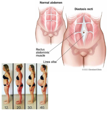 <p>Diastasis recti</p>