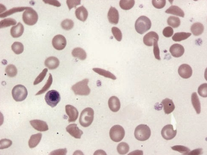 <p>what anemia is this? what is the inclusion present?</p>
