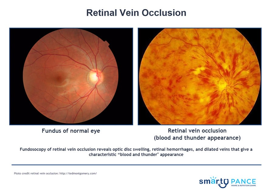 <p>“Blood and thunder fundus”, which usually occurs secondary to a thrombotic event that is most common in ages 50+, associated with hypertension, glaucoma, diabetes, and hyperviscosity states </p><p>-Dx: fundoscopy shows retinal hemorrhages, optic disc swelling </p><p>-Tx: vision resolves with time, workup for thrombosis </p>