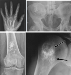 <p>What is this?</p><p>- 40-60 yo, Male</p><p>- Pain (Minor palpable swelling, can be asymptomatic)</p><p>- Metadiaphyseal - Pelvis, proximal & distal femur, humerus, ribs, scapula, proximal tibia, hand, foot, spine</p>