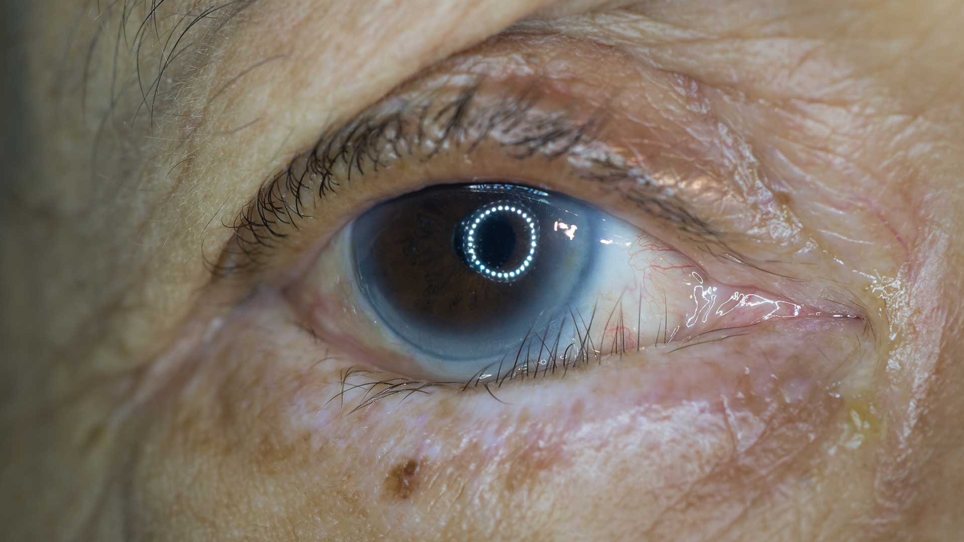 <p>lower eyelid rolling inward</p>