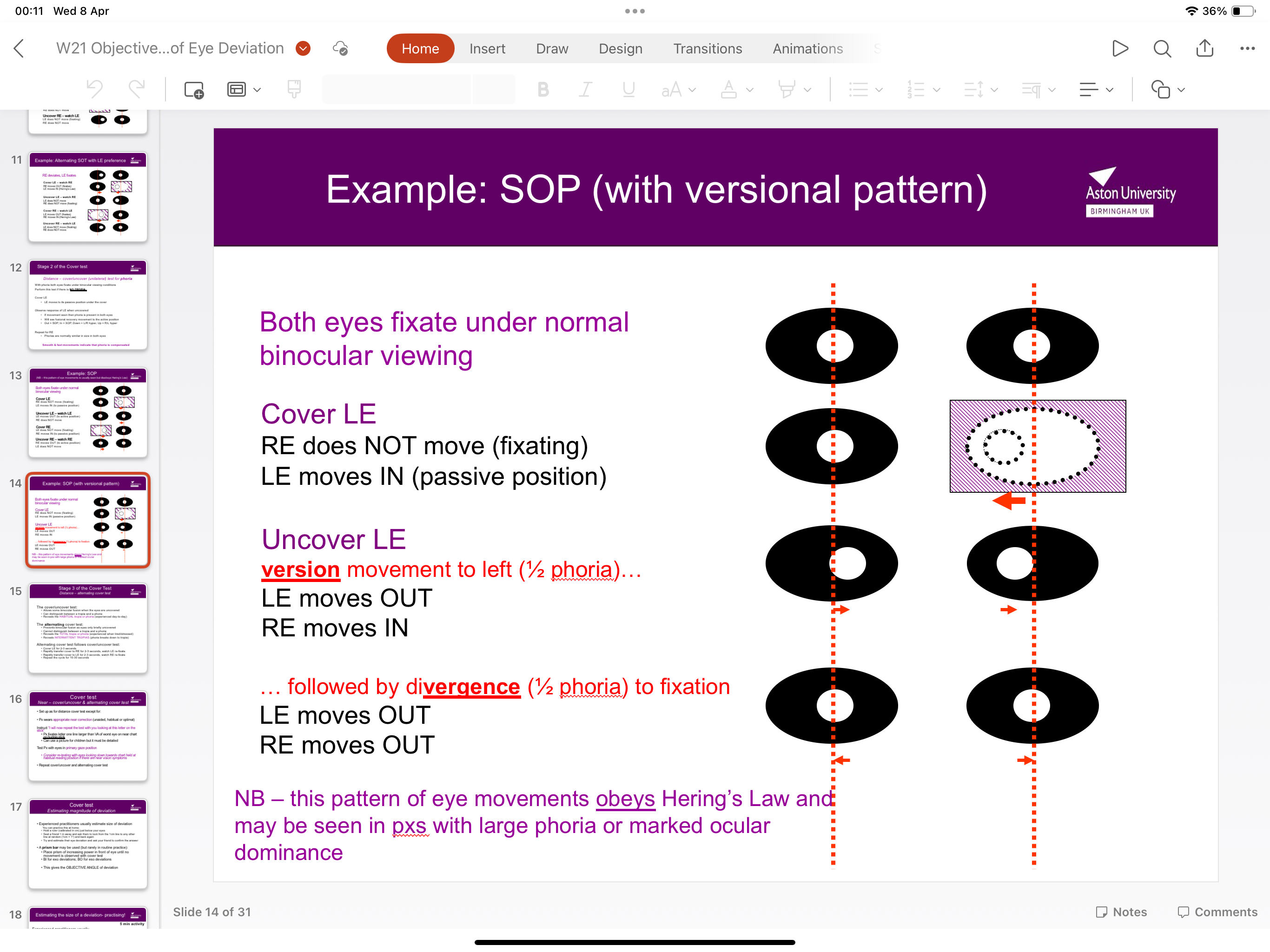 <p>When a big phoria is obeying Herring’s law- when the eye reverts to its original position, both eyes will wobble- a version movement (same) is seen, followed by vergence (different) </p>