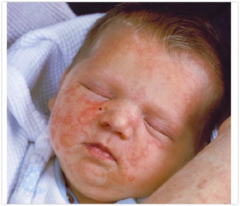 <p>- Clustered vesicles present only in 35% infected newborns</p><p>- encephalitis</p><p>- can disseminate and look like sepsis</p><p>- seizures</p><p>- sx not seen til end of 1st or 2nd week of life</p>