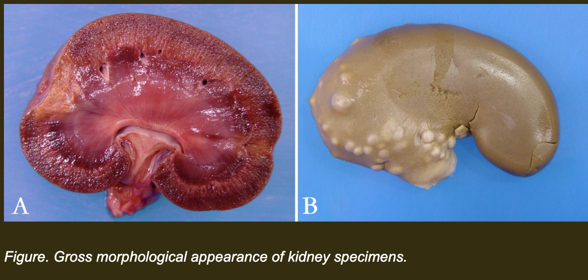 <p>Now examine two additional kidney specimens — Kidney A and Kidney B. Both are abnormal. Your team must compare them using neutral morphologic language only.</p><p><strong>Which description most accurately compares Kidney A and Kidney B using neutral morphologic language — without diagnostic interpretation?</strong></p><p><span>a. Kidney A contains a focal, wedge-shaped, pale, dry lesion with a depressed capsular surface. Kidney B contains multifocal, round, pale nodules of varying sizes that are raised above the capsular surface, giving the organ an irregular contour.</span></p><p><span>b. Kidney A contains an infarct caused by vascular occlusion. Kidney B contains bacterial abscesses from embolic seeding.</span></p><p><span>c. Kidney A contains a large abnormal damaged area. Kidney B contains irregular lumpy tissue.</span></p><p><span>d. Both kidneys contain diffuse pale lesions extending through the entire organ.</span></p>