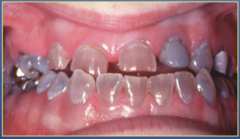 <p>-teeth appear blue-grey or amber-brown and opalescent</p><p>-narrow roots with little to no pulp chamber </p><p>-bulbous crowns</p><p>-Enamel splits readily from dentin when subjected to force</p>