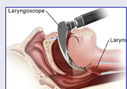 <p><span style="background-color: transparent;">Laryngoscope</span></p>