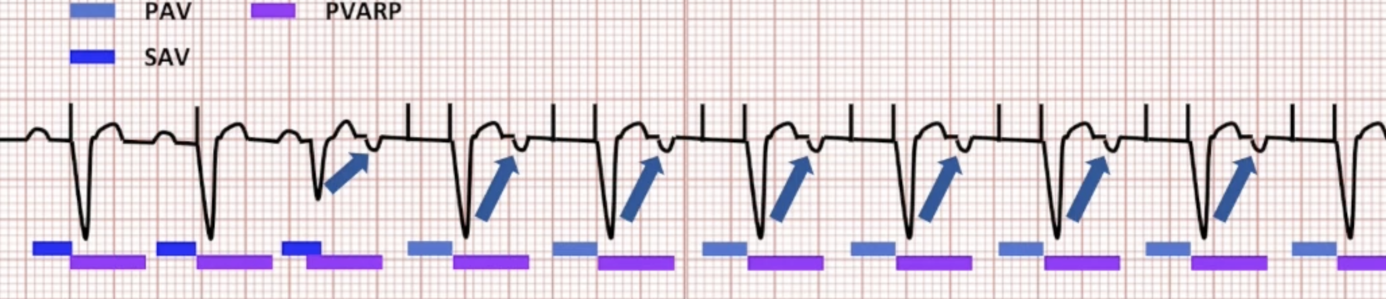 <ul><li><p>Atrium paced again: FUNC</p></li><li><p>Pattern continues:</p><ul><li><p>Loss of optimal AV delay</p></li><li><p>Unnecessary RV pacing</p></li><li><p>Possible triggering of arrhythmias/algorithms</p></li></ul></li></ul><p></p>