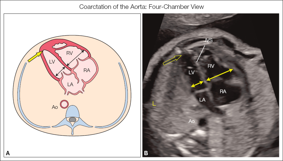 <p>Narrowing of the aortic arch</p><p>Right ventricular enlargement</p><p>Pulmonary artery enlargement</p>