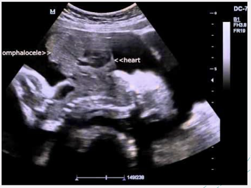 <ul><li><p>rare syndrome causing defects involving 5 abnormalities:</p><ul><li><p>anterior <span style="color: red;">diaphragmatic hernia</span></p></li><li><p><span style="color: red;">high omphalocele (primary finding)</span></p></li><li><p><span style="color: red;">intracardiac defect</span></p></li><li><p><span style="color: red;">ectopia cordis</span> (cleft defect in lower sternum)</p></li><li><p><span style="color: red;">defect of diaphragmatic pericardium</span></p></li></ul></li><li><p>prognosis: very poor</p></li><li><p>associated with various defects</p></li></ul><p></p>