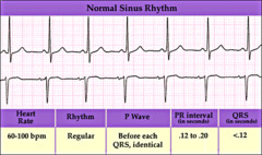 <p>-P wave for every QRS (SA node- Sinus) </p><p>-Regular (R waves all same distance) </p><p>-Rate 60-100</p>