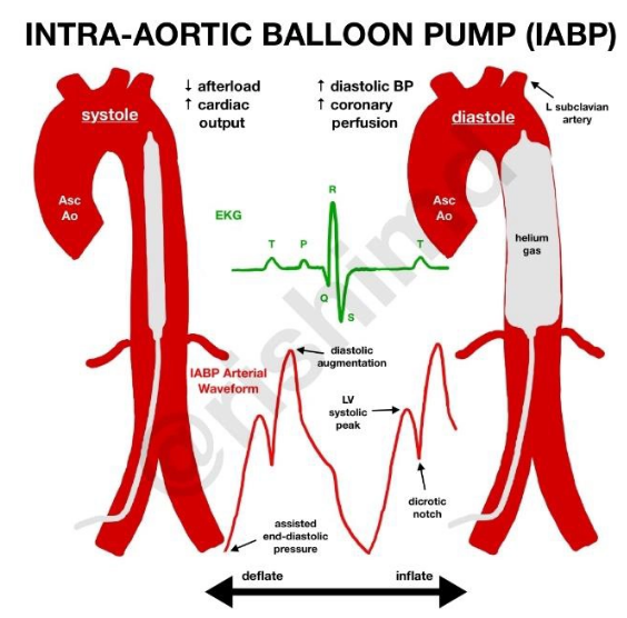 <ul><li><p>placed in thoracic aorta balloon inflated during diastole</p><ul><li><p>increasing aortic pressure during diastole and incrasing coronary blood flow</p></li></ul></li><li><p>balloon deflated prior to and during early left ventricular ejection</p><ul><li><p>reduces aortic pressure + afterload</p></li></ul></li></ul><p></p>
