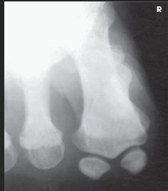 <p>The Holly method is used when the patient is</p>