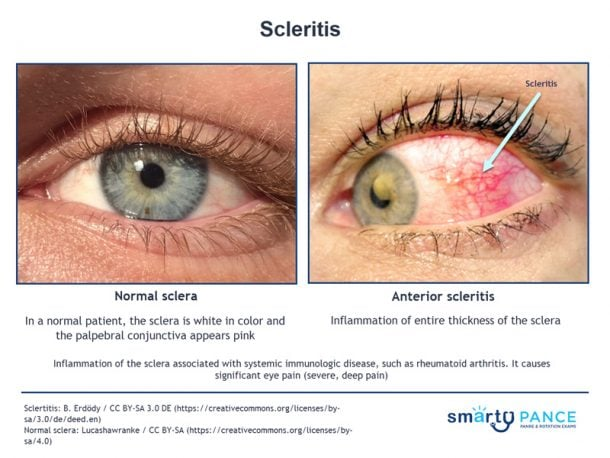 <p>Inflammation of the sclera, which is usually severe, vision-threatening, and associated with systemic autoimmune disease (SLE, RA)</p><p>-Presentation: severe deep boring eye pain that radiates to the face/jaw which is worse at night and wakes patient up from sleep, violaceous scleral hue, tearing, photophobia, redness does not blanch with topical phenylephrine </p><p>-Dx: slit lamp exam</p><p>-Tx: oral NSAIDs, systemic corticosteroids + immunosuppressants </p>